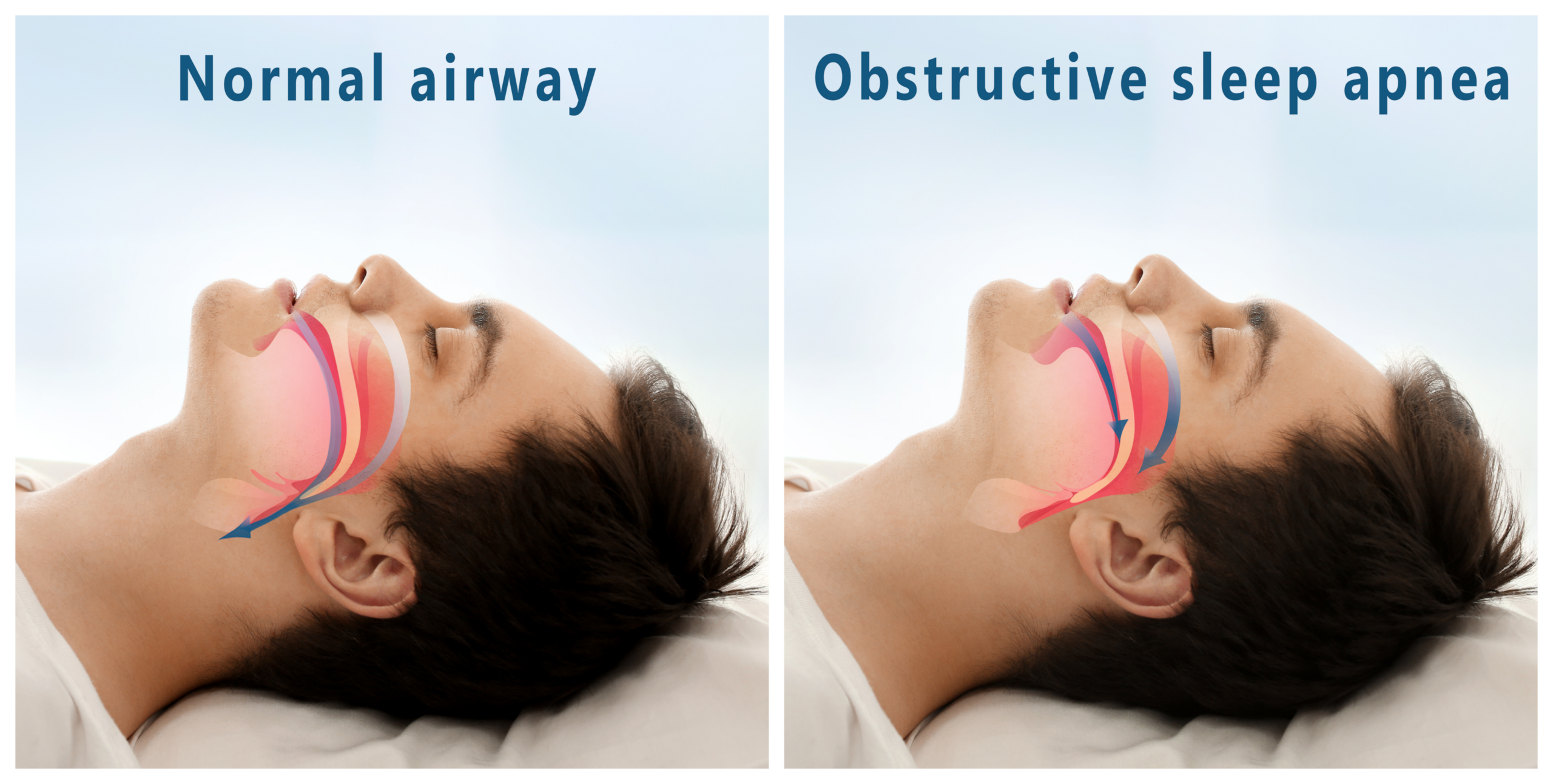 sleep apnea types and symptoms